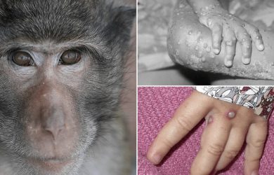 Τι είναι η ευλογιά των πιθήκων (monkeypox), ποια είναι τα συμπτώματα και πως μεταδίδεται